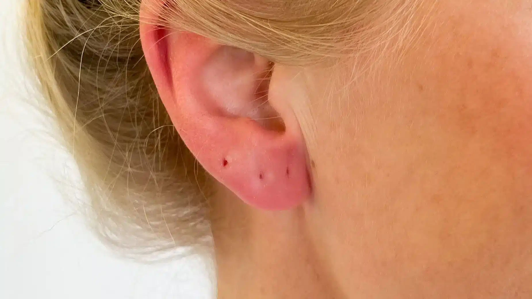 infected ear piercing